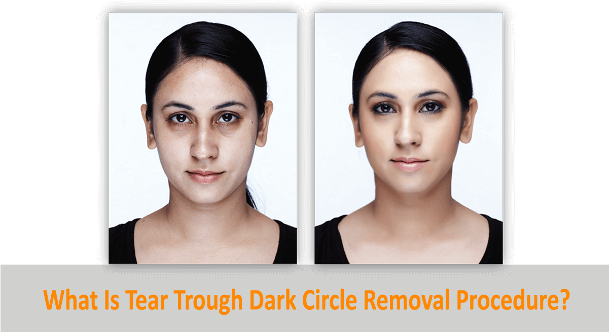 What Is Tear Trough Dark Circle Removal Procedure - Dark Circle Eye Roller Before And After (1200x800), Png Download