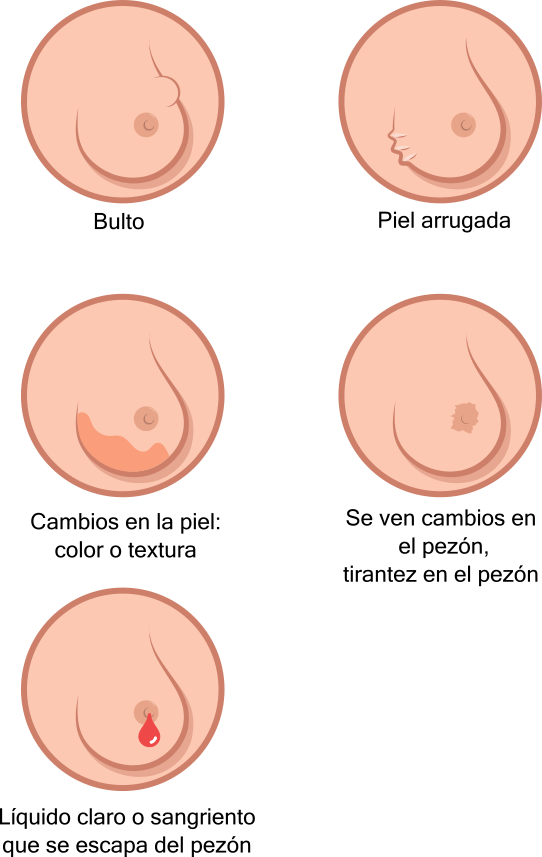 Breast Cancer Illustration Es - Breast Cancer (542x857), Png Download