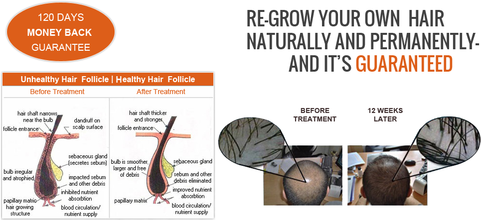 Laser Hair Loss Treatment Therapy - Laser Hair Therapy (967x509), Png Download