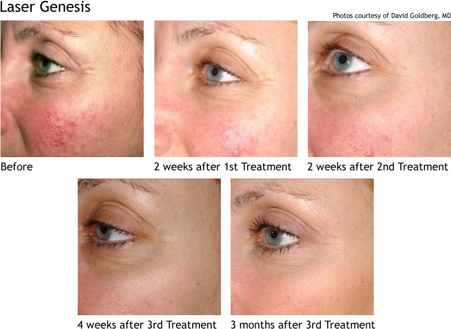 Laser Genesis Skin Therapy - Laser Genesis (920x680), Png Download