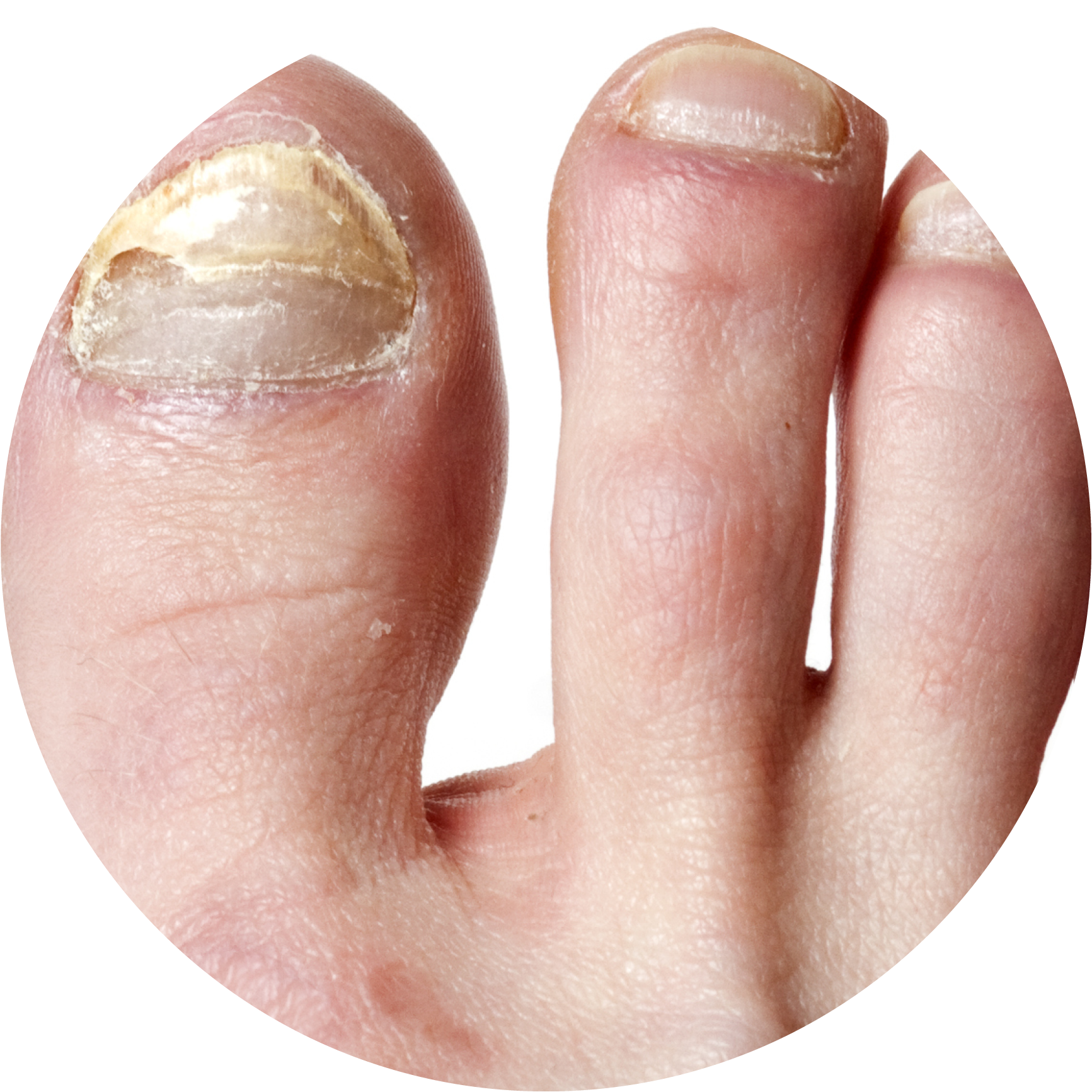 Nail Infection Circle - Natural Way To Get Rid Of Toenail Fungus (1733x1733), Png Download