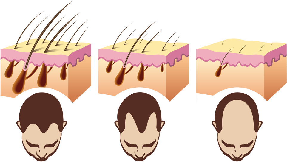 Hair-loss - Sebamed Anti Hair Loss Shampoo Review (1000x591), Png Download
