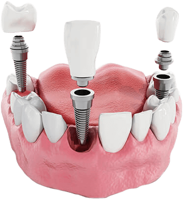 Port Jefferson Smiles Karen Halpern Dmd, Ms Dental - Impianto Dentale Straumann (593x458), Png Download