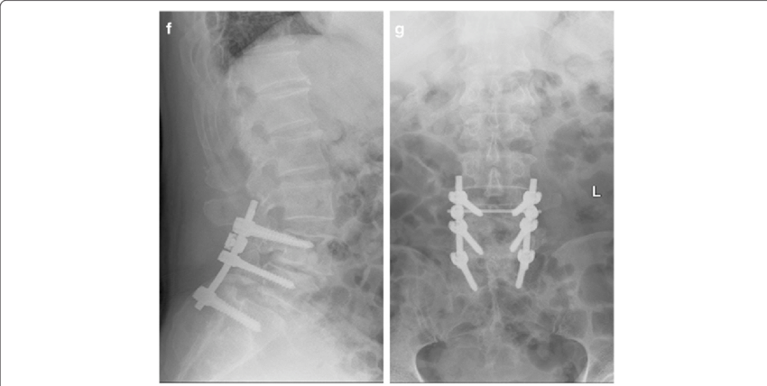 F, G Postoperative Lumbar Spine Showing L4-l5 Correction - Lumbar Vertebrae (850x428), Png Download