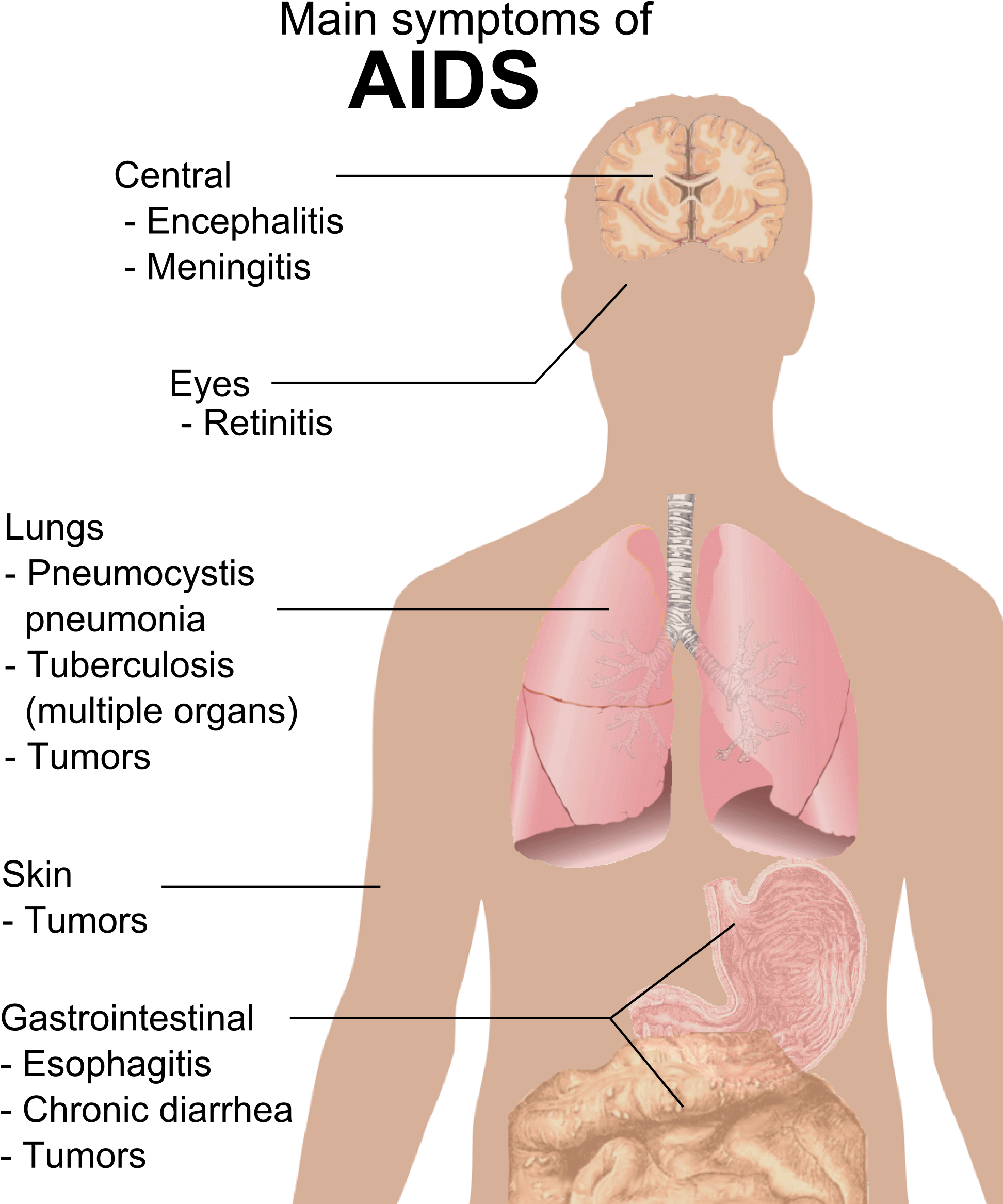 Symptoms Of Aids (1960x2369), Png Download