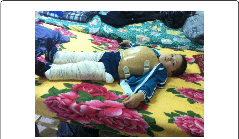 Equipment-two Plaster Splint And A Garchoix Corset - Orthopedic Cast (769x447), Png Download