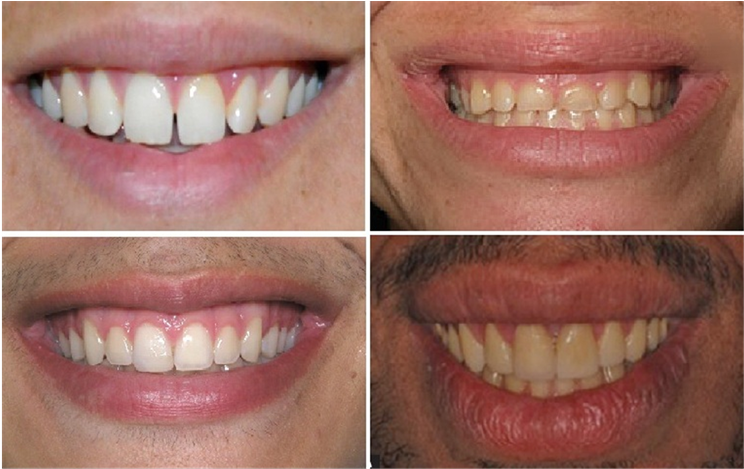 A Standardized Smiling Frontal Photograph Was Taken (903x468), Png Download