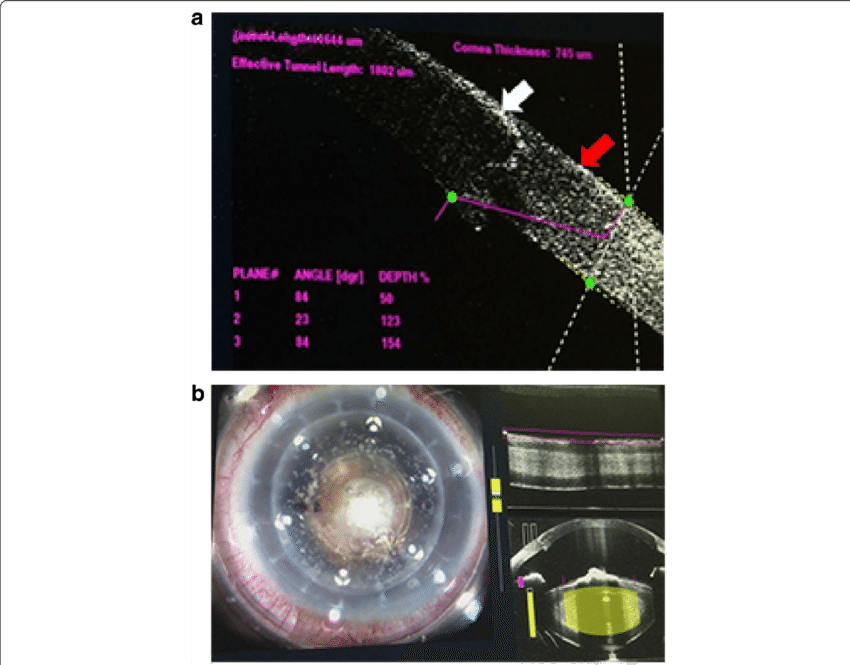 The White Arrow Indicates The Corneal Graft - Capsulotomy (850x665), Png Download