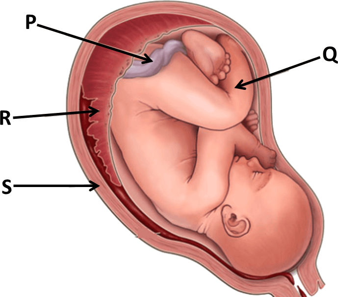 Image Showing Pregnancy - Placenta Previa (689x605), Png Download