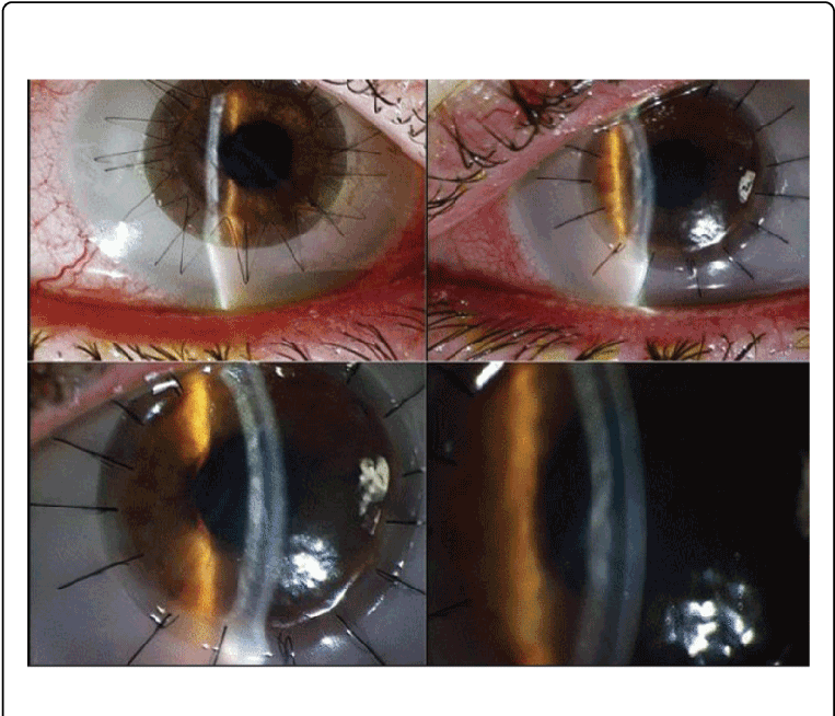 Post Dalk Images (sibling 1) Of Right And Left Corneas - Cornea (769x657), Png Download