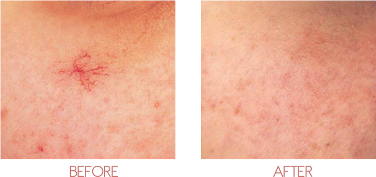 About - Facial Vein (800x400), Png Download