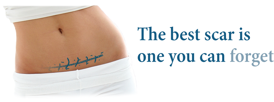 Here Are Some Of The Many Benefits - Kelo Cote Before And After Keloid (961x359), Png Download