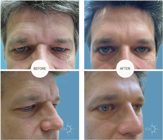 Forehead Lift - Montreal (600x600), Png Download