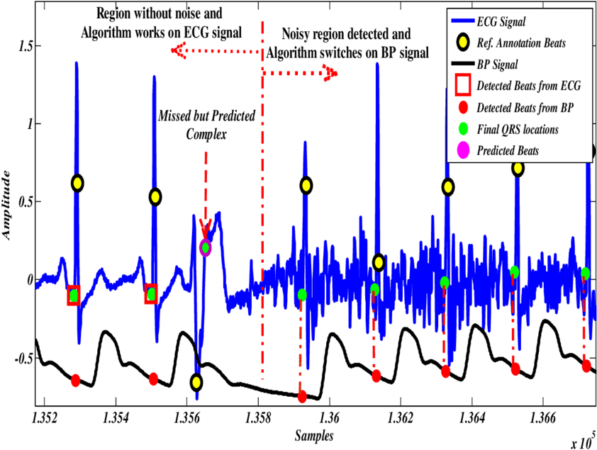 In Noisy Zones Of Ecg, Bp Signal Will Be Used For Heartbeat - Heartbeat Detection Algorithm (850x646), Png Download