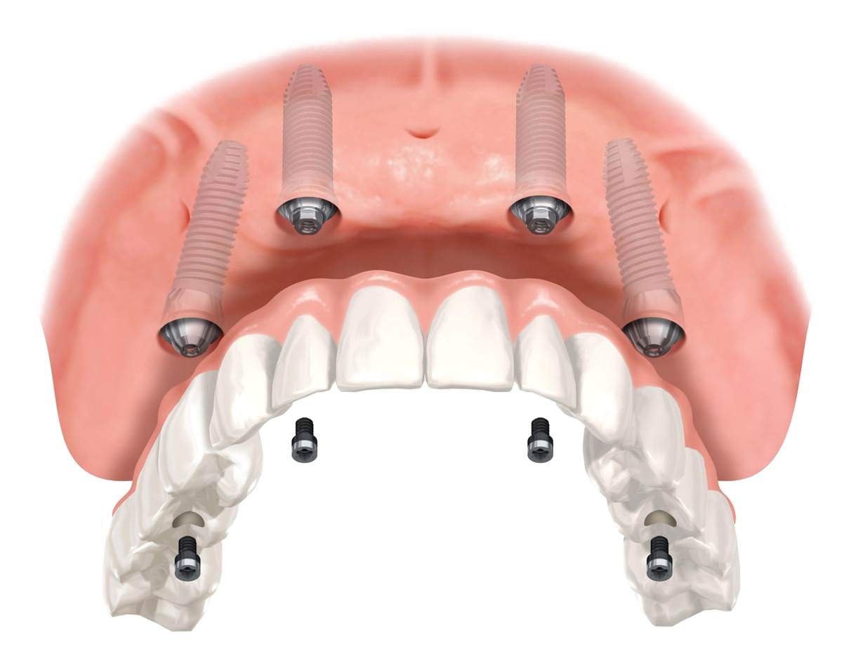 They Are Versatile Attachments Which Allow A Wide Variety - All On 4 Upper (1212x948), Png Download