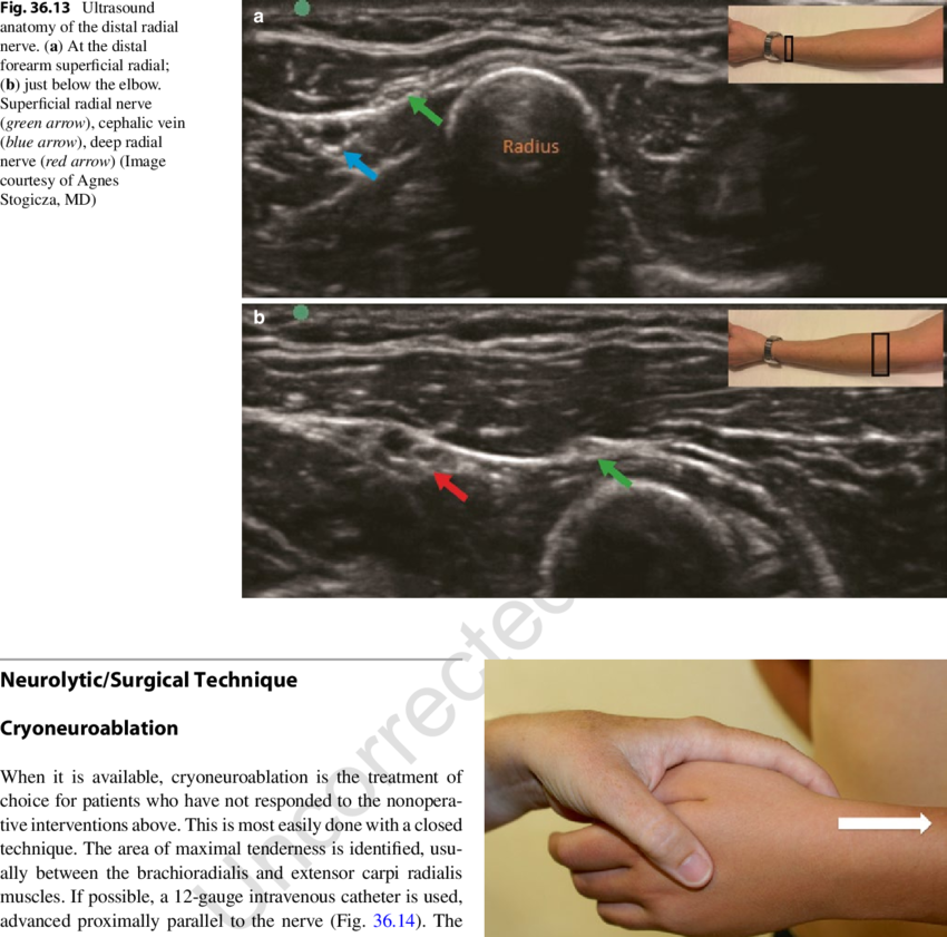 14 Direction Of The Cryoprobe For Cryoneuroablation - Superficial Radial Nerve Ultrasound (850x841), Png Download