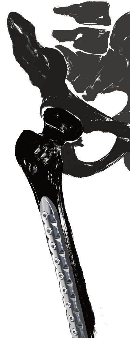 0mm Screw System In Femur A - Illustration (460x1100), Png Download