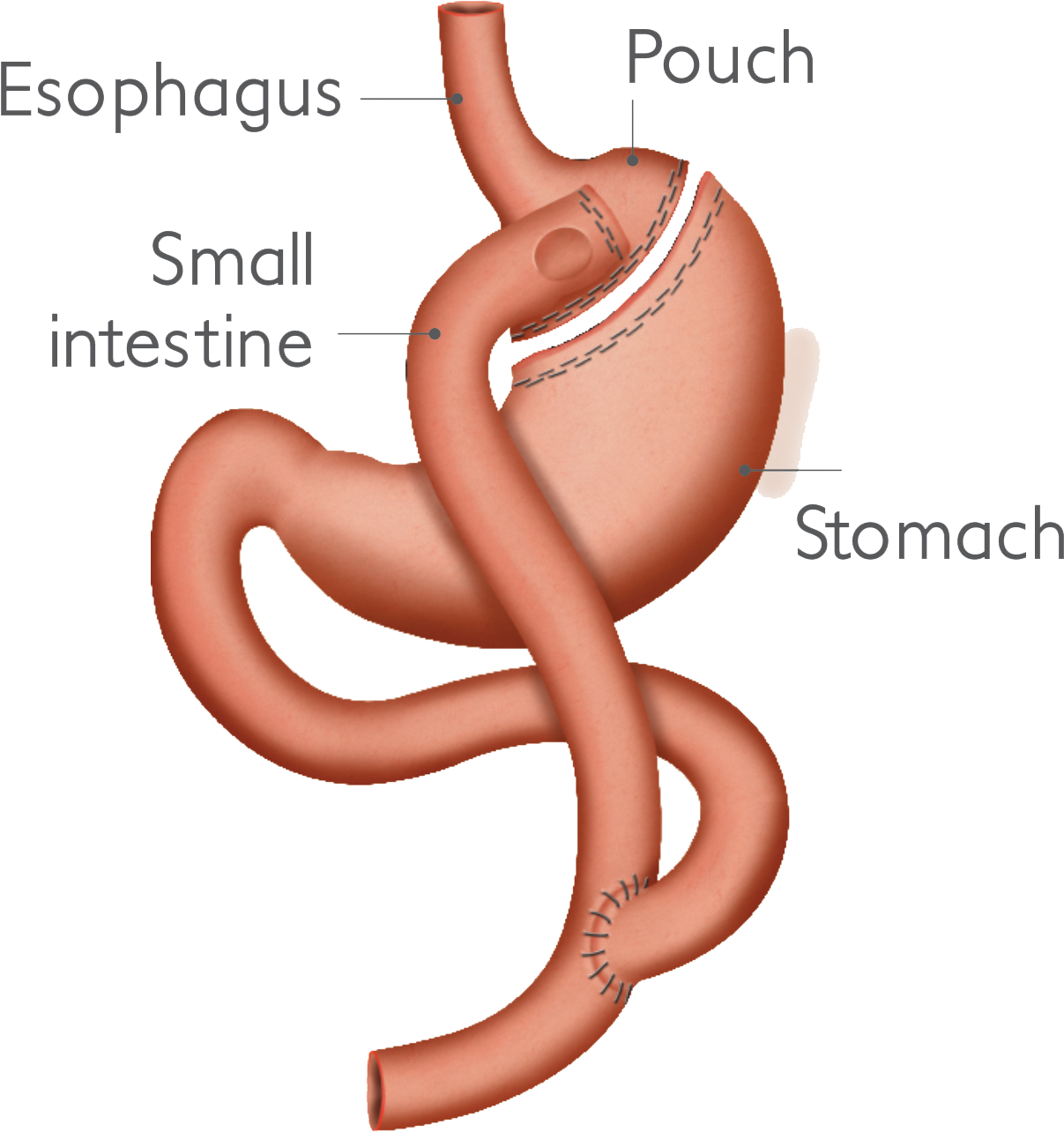 Laparoscopic Roux En Y Gastric Bypass (2482x1467), Png Download