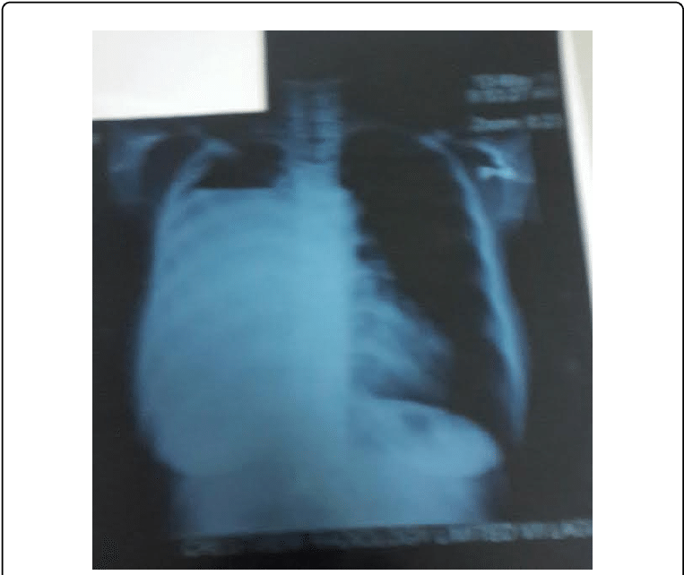 Chest X-ray At Presentation (769x645), Png Download