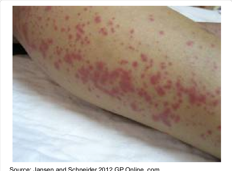 Skin Rashes - - Leptospirosis Skin Rash (761x561), Png Download