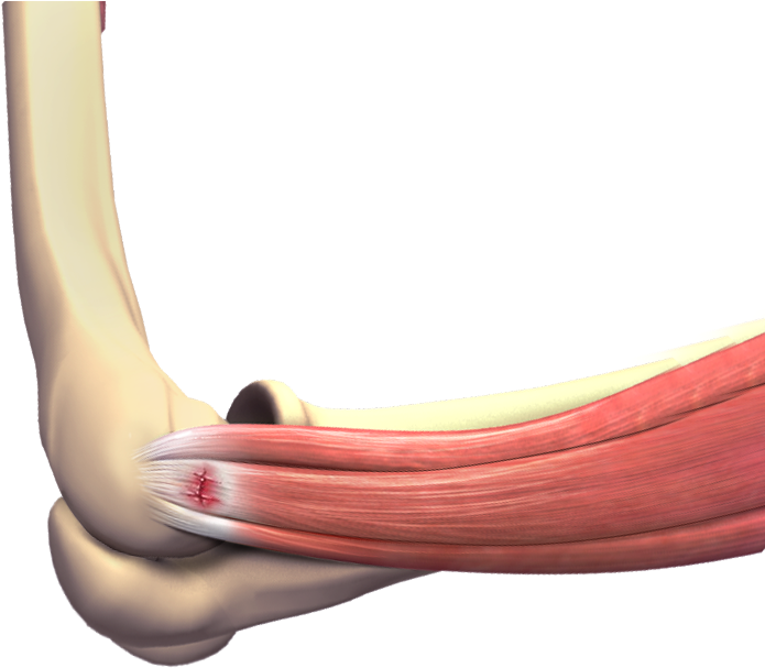 Tennis Elbow - Tennis Elbow Surgery (784x620), Png Download