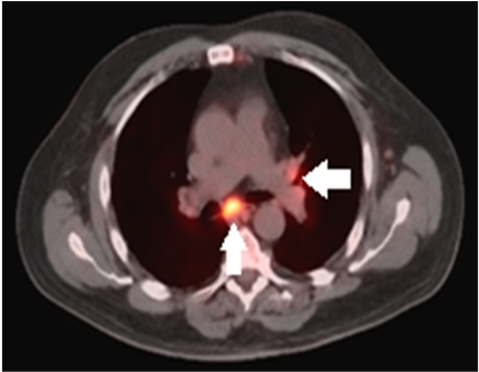 Pet/ct Of Head/thorax - Mediastinal Lymph Node (903x341), Png Download