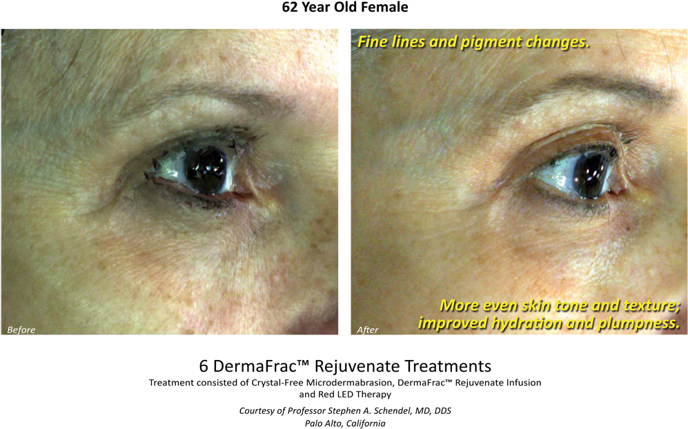 Va Before & After Dermafrac Skin Rejuvenation Injections - Dermafrac Before And After (1000x699), Png Download