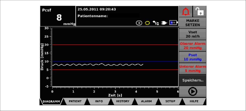 Liquoguard Monitor Demonstrating Current Cerebrospinal - Journal Of Endovascular Therapy (850x384), Png Download