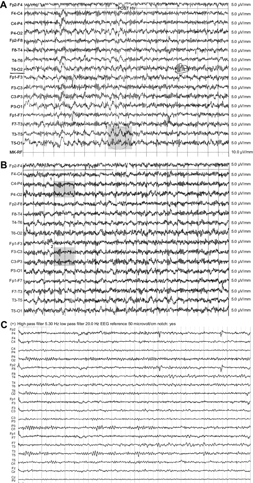 First Eeg Pattern Of The Patient - Delta Wave (850x1621), Png Download