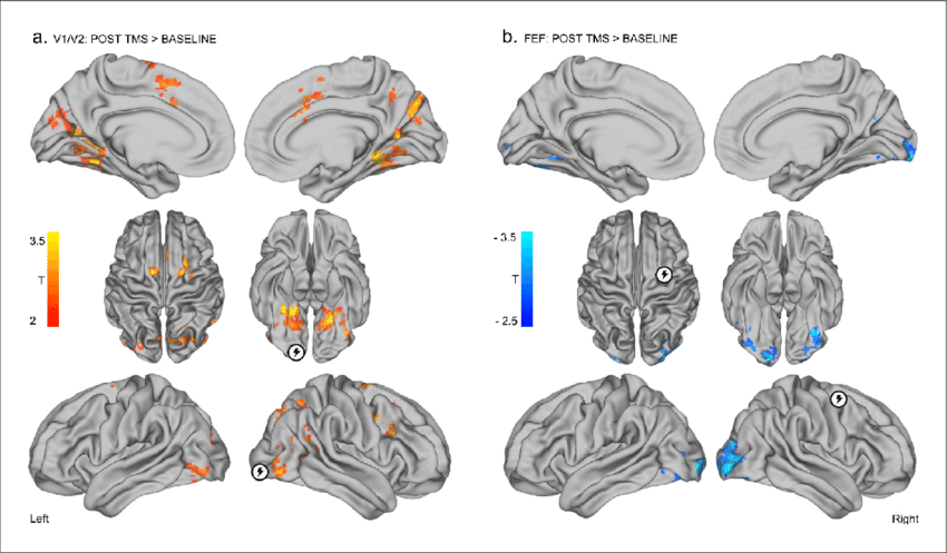 Distinct Effects Of Local Inhibitory Tms Over Early - Occipital Pole (850x497), Png Download