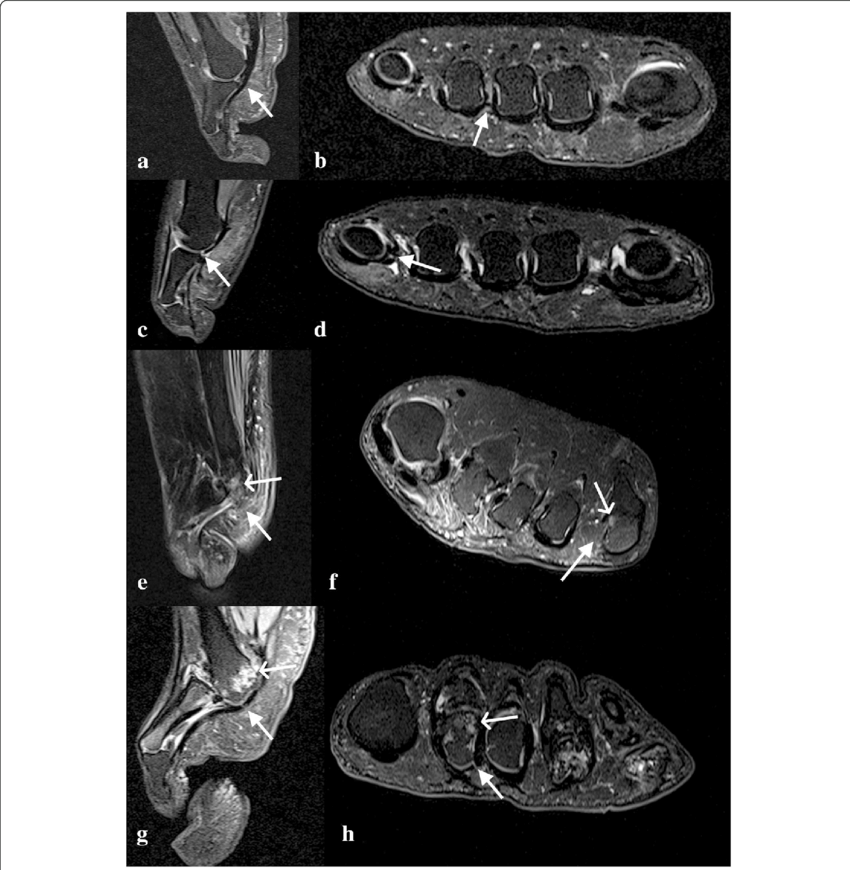 Intermediate Weighted, Fat Suppressed Sagittal And - Fat (850x870), Png Download