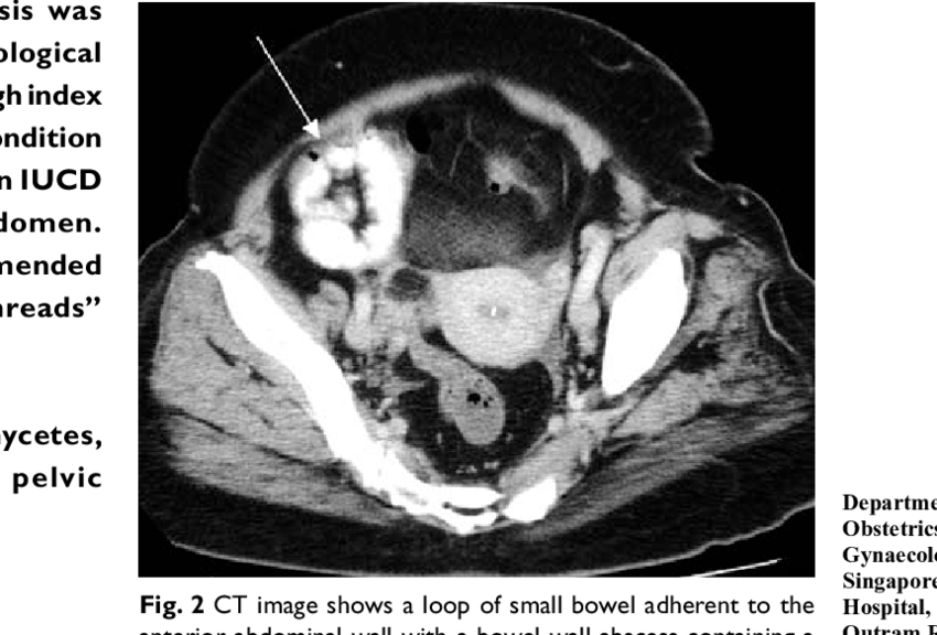 Ct Image Shows Inflammatory Stranding Of Fat And A - Pelvic Ct That Shows An Ovarian Mass (850x576), Png Download