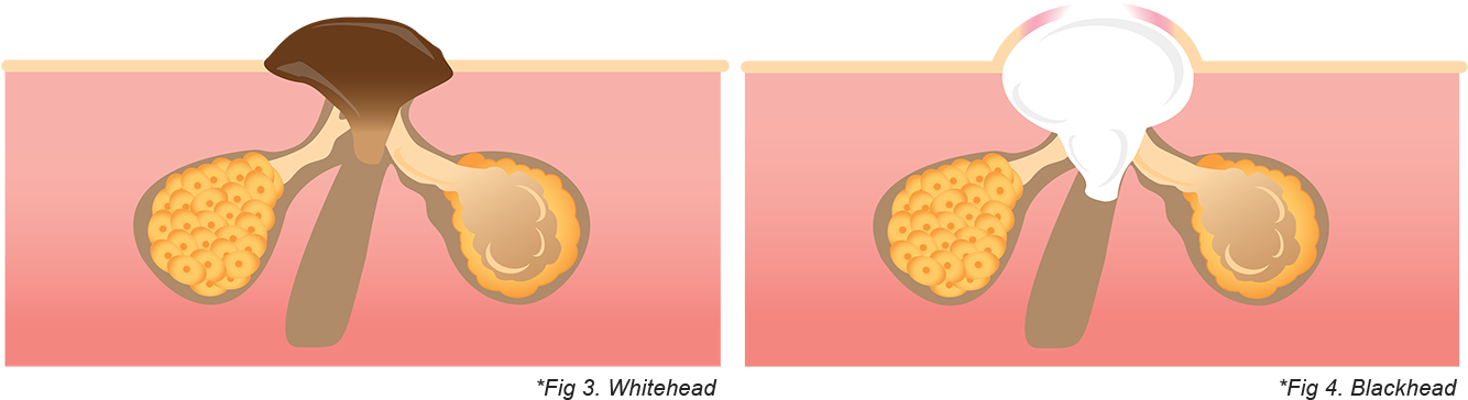 Acne Scars Graphic - Illustration (1335x380), Png Download