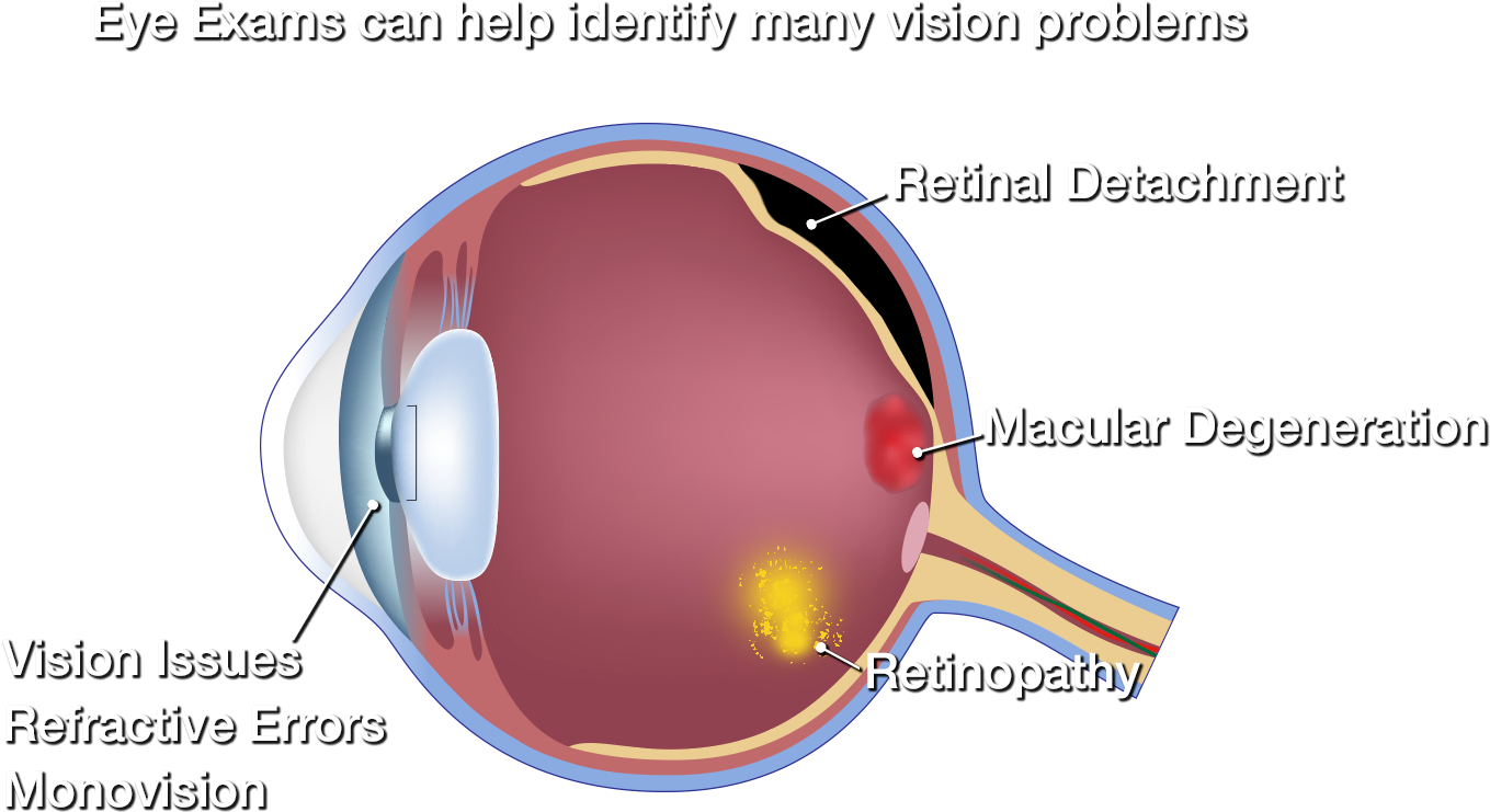 Side View Of Eyeball Side View Of Eyeball - Diagram Of Macular Degeneration (1600x850), Png Download
