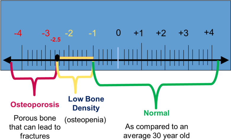 Understanding Bone Density Results (820x491), Png Download