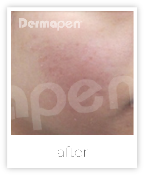 Dermapen Acne Scars - Dermapen Before After (513x618), Png Download