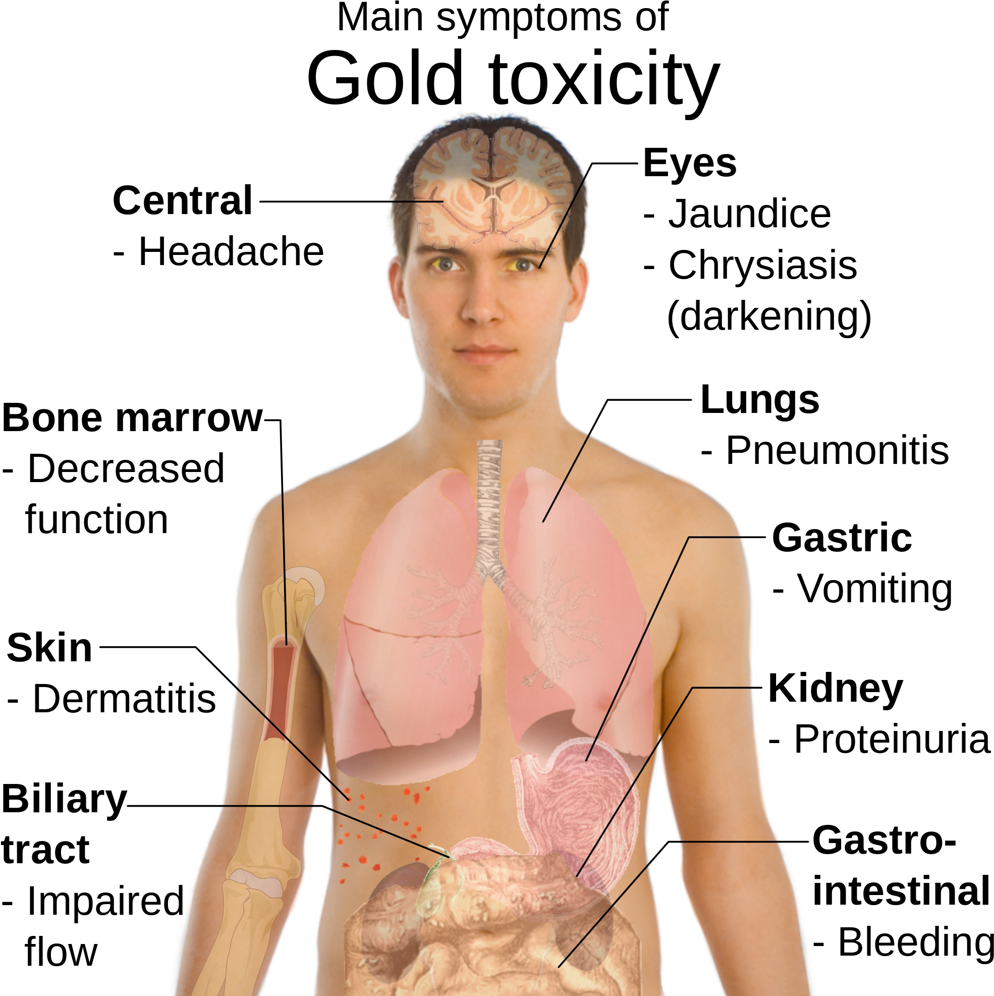 Open - Pneumonia Sinais E Sintomas (2000x1989), Png Download