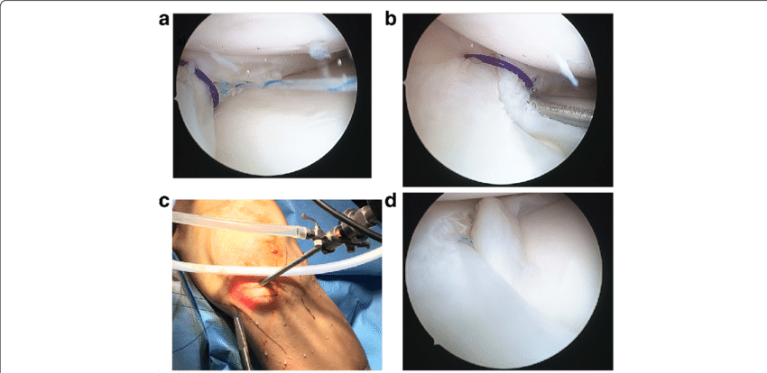 Intra Operative Images Showing The Final Repair - Television Show (850x414), Png Download