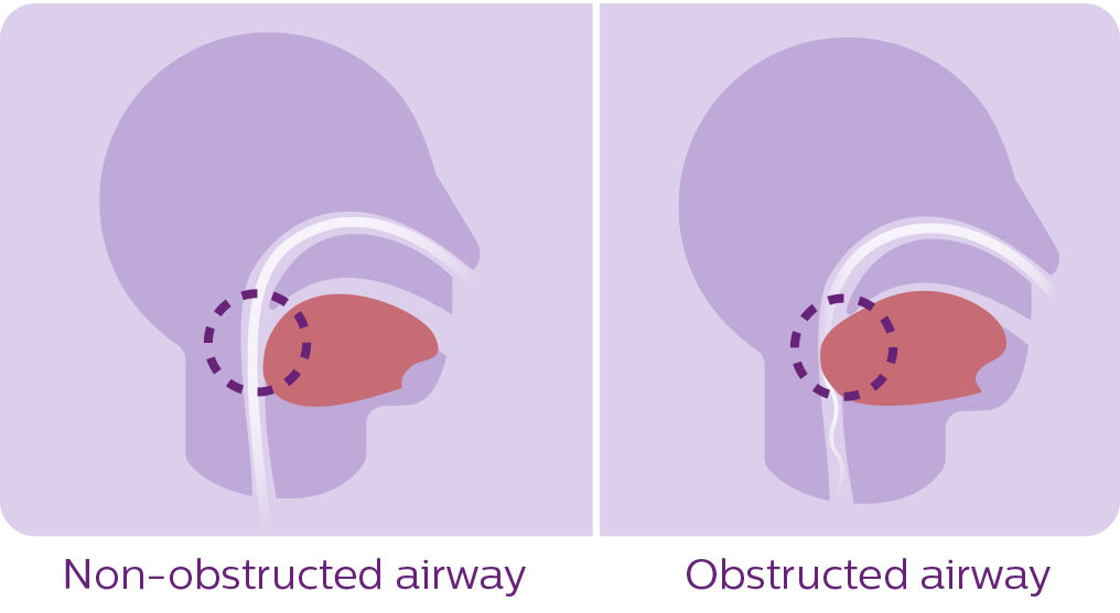 Sleep Apnea Diagram - Sleep Apnea (1016x556), Png Download