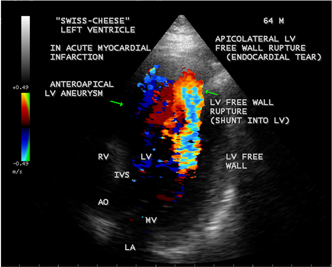 Apical 3 Chamber View Showing The Apicolateral Lv Free - Ventricular Free Wall Rupture Echo (903x543), Png Download