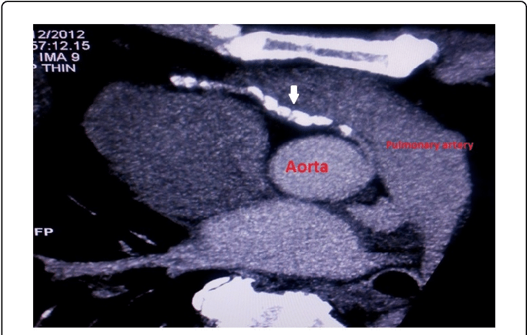 Gd-enhanced Ct Angio With Mip Image Showing Anomalous (769x489), Png Download