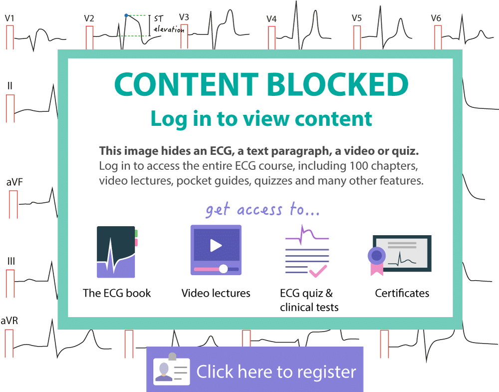 The Ecg Leads Includes The Limb Leads And The Chest - Cardiac Stress Test (1000x785), Png Download