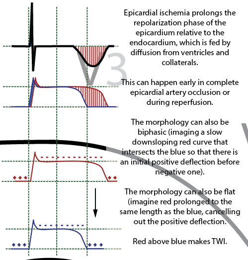 Spontaneous Reperfusion Or Decreasing Demand On The - Diagram (499x523), Png Download