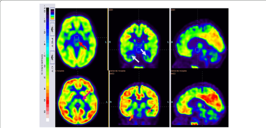 18 F-fdg Image Before Cellular Therapy Showing Reduced - Common Fig (850x410), Png Download