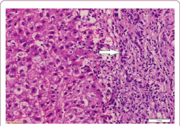 High Power View Of The Previous Slide Showed Numerous - Fibrosis (769x538), Png Download