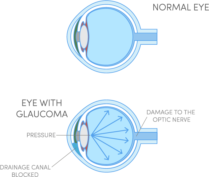 What Is Glaucoma - Circle (846x738), Png Download