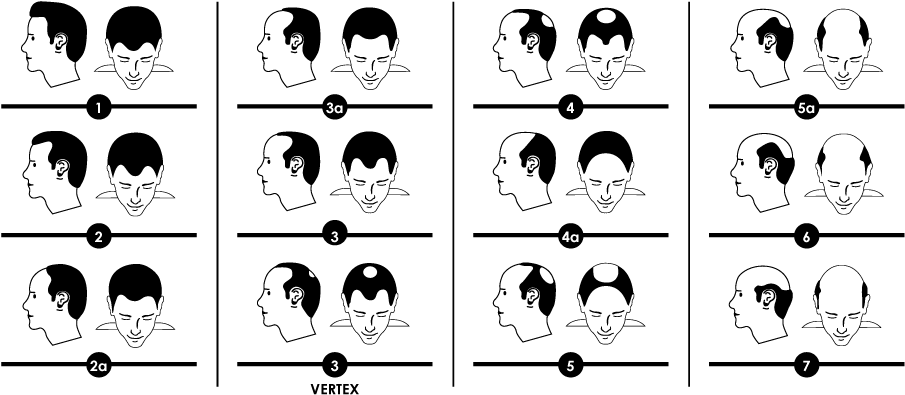 Norwood Scale For Male Hair Loss (919x432), Png Download