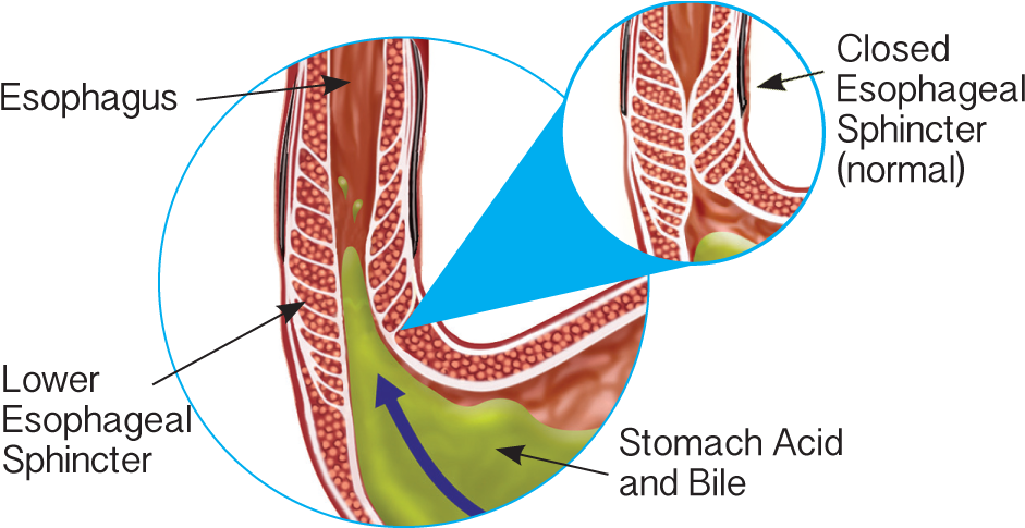 Gerd Lower Esophageal Sphincter - Stomach (949x494), Png Download