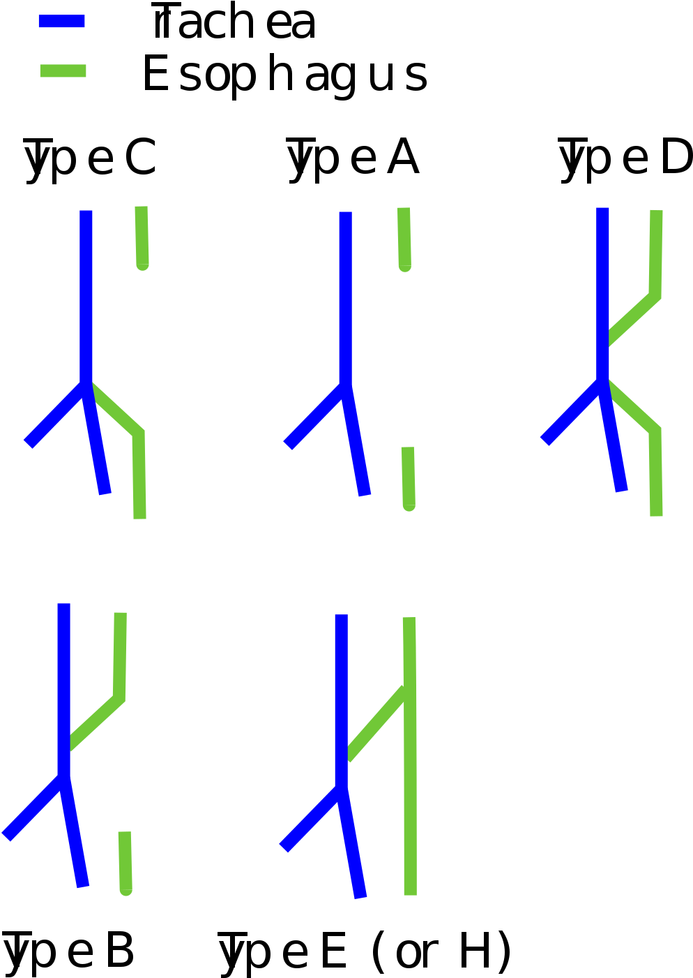 Tracheoesophageal Fistula Types (1200x1531), Png Download