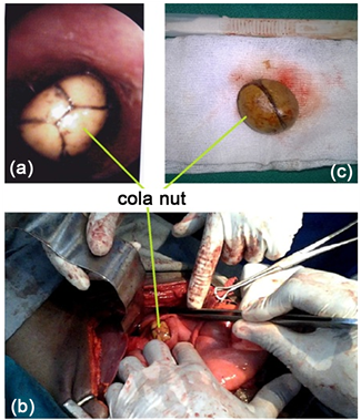 Endoscopic View Of The Cola Nut Blocked In The Esophagus - Esophagus (903x378), Png Download